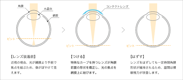 オルソケラトロジーの仕組み