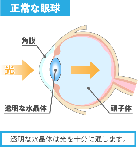 正常な眼球 透明な水晶体は光を十分に通します。