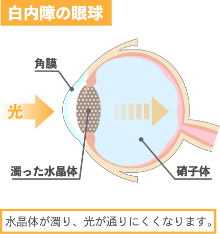 白内障の眼球 水晶体が濁り、光が通りにくくなります。