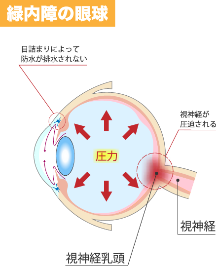 緑内障の眼球